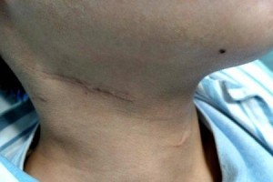 狗甲状腺发炎症状一览（了解狗甲状腺发炎的常见症状和治疗方法）