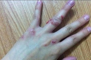 法斗犬湿疹困扰（法斗犬湿疹的常见症状、治疗方法与预防措施）