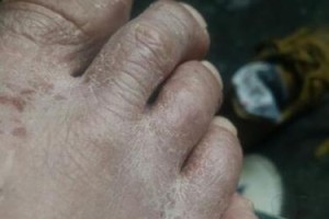 猫脚烂擦的药物治疗方法（选择合适药物是关键，你知道吗？）