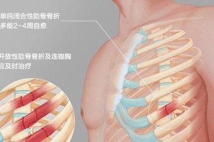 狗狗肋骨骨折的康复时间及注意事项（了解狗狗肋骨骨折的康复过程和必要的护理措施）