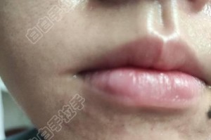 嘴唇米白色颗粒的成因及处理方法（了解嘴唇米白色颗粒的种类和产生原因，学会正确处理与预防）