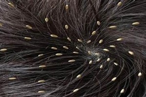 人类身上为什么长虱子？（揭开人体寄生虫之谜，探寻虱子生存的奥秘）