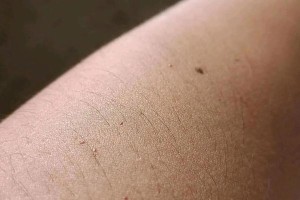 狂犬苗过敏（了解狂犬苗过敏的常见症状及应对措施）