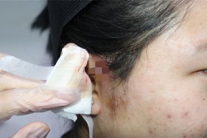 耳朵磨破了该涂什么药膏？（耳朵磨破了怎么办？耳朵磨破了可以用什么药膏治疗？）